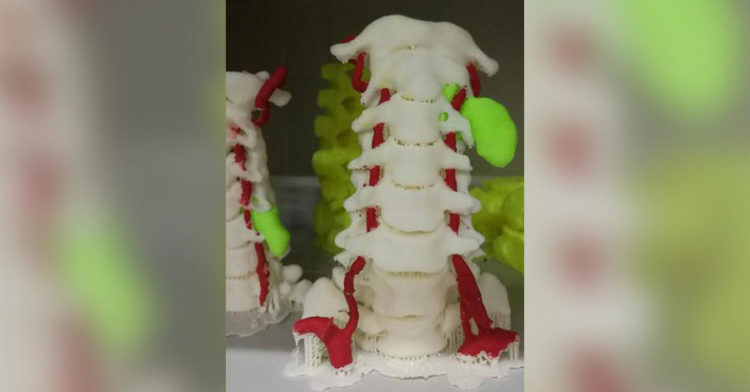 3D Printing in Medicine: Spinal Surgeries See Increased Success Rate with 3D Printed Guides