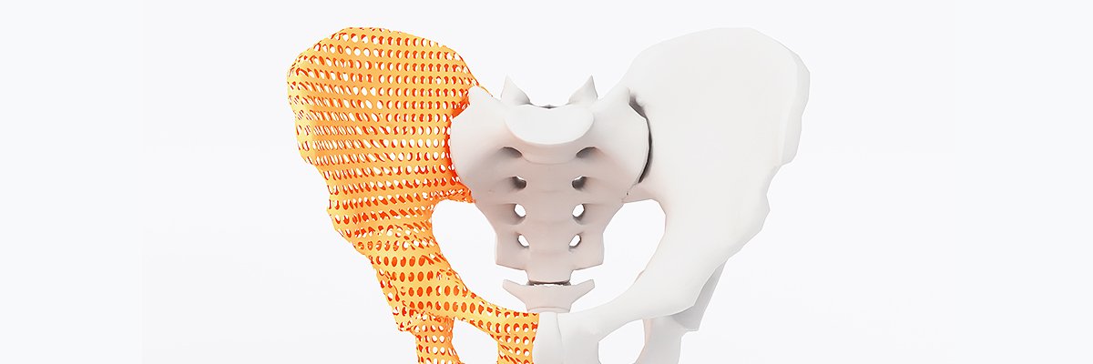 3D Printing in Medicine: Surgical Planning Successfully Using 3D Printed Bone Models