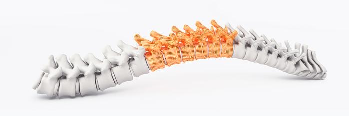 3D Printing in Medicine: Spinal Surgeries See Increased Success Rate with 3D Printed Guides